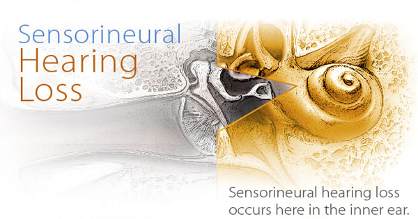 Sensorineural Hearing Loss