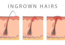 How long do ingrown hairs last