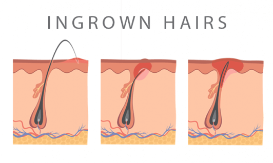 How long do ingrown hairs last