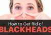 How to Get Rid of Blackheads